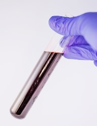 Geyserville CA phlebotomist holding blood sample